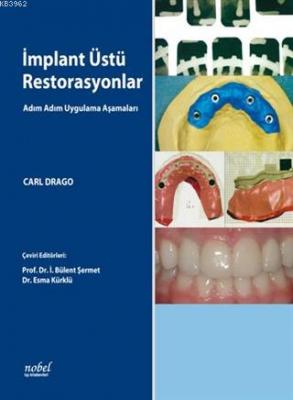 İmplant Üstü Restorasyonlar: Adım Adım Uygulama Aşamaları